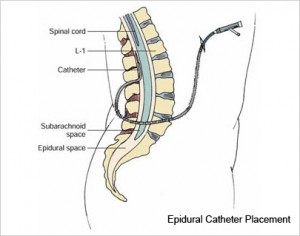 Epidural Catheter