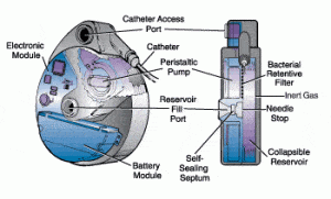 Intrathecal Drug Delivery